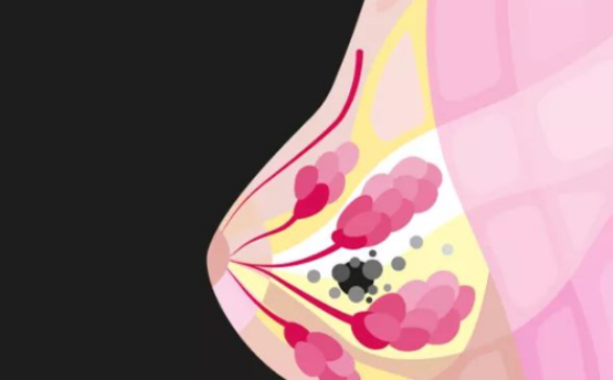 <b>内分泌治疗与CDK4/6抑制剂的联用给晚期乳腺癌带来新方向</b>药厂实拍