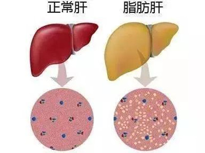 <b>奥贝胆酸对肝硬化脂肪肝治疗好不好？</b>药厂实拍