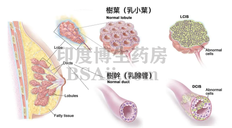 得了乳腺癌就必须切除乳房吗？药厂实拍